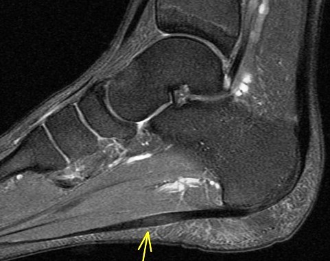 Figure 2 for case Juvenile plantar fibromatosis